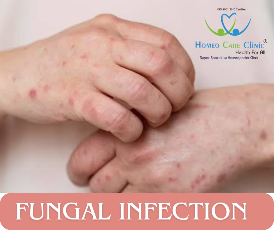 Skin Fungal Infection