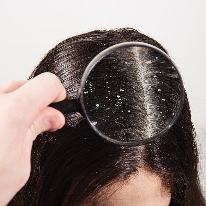 How to Get Rid of Dandruff