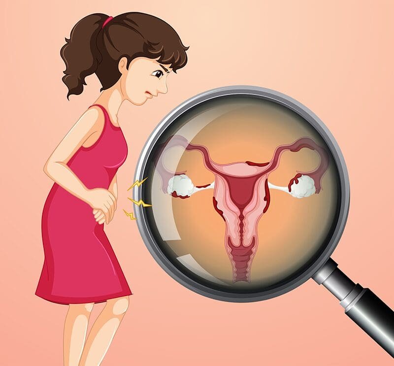 Natural homeopathic remedies for PCOD/PCOS