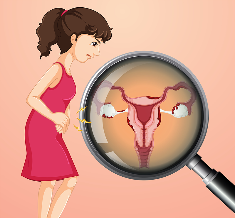 Natural homeopathic remedies for PCOD/PCOS