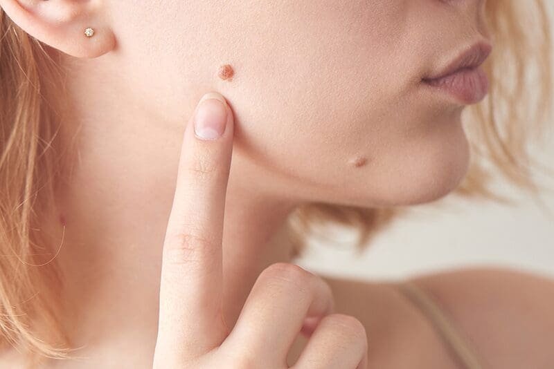 Homeopathic wart removal safe and natural treatment