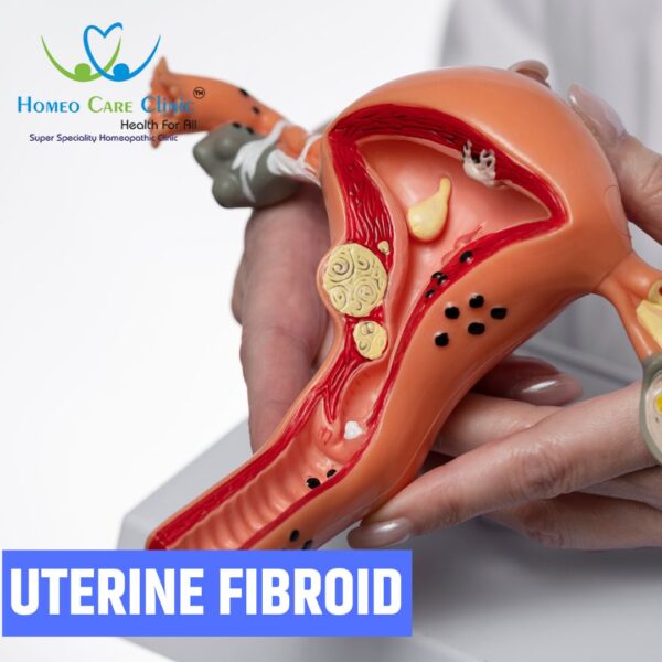 homeo medicine for fibroids in uterus