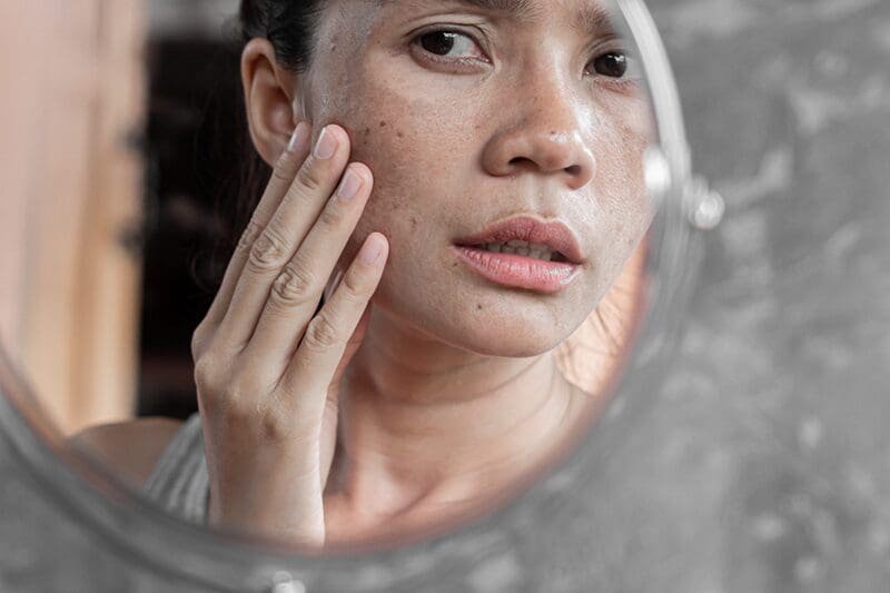 Homeopathic Treatment on Hyperpigmentation