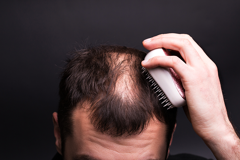 Treatment For Patchy Hair Loss (Alopecia Areata)