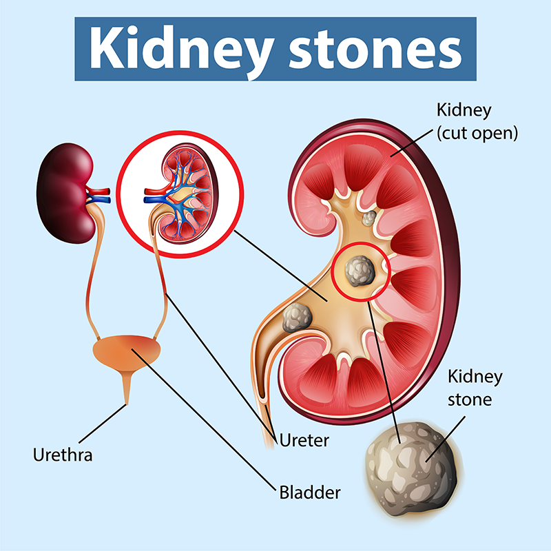 case study about kidney stones