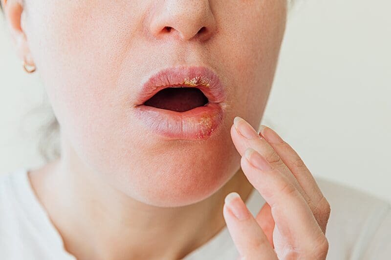 Mouth ulcer treatment remedy