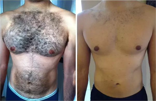 Body Hair Removal Treatment | Homeo Care Clinic