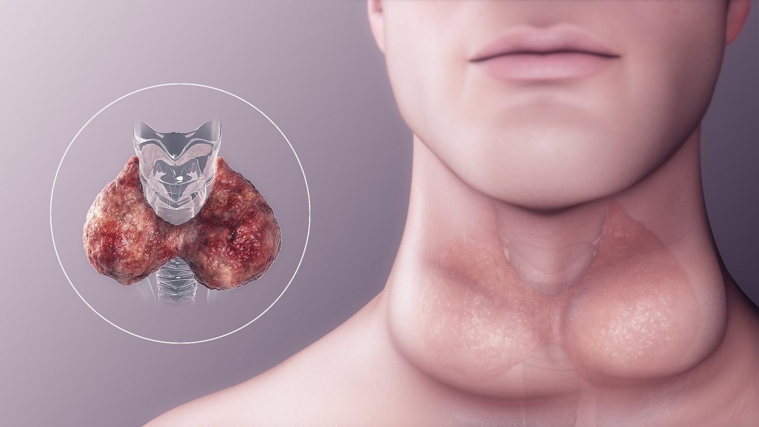 Hypothyroid treatment in pune