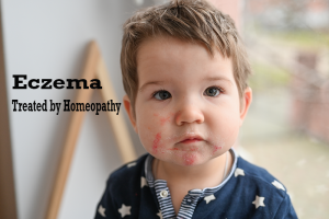 Homeopathy Eczema treatment in Pune