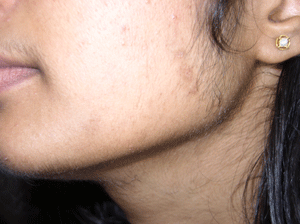 Chin hair: Causes in females, removal, and what to know