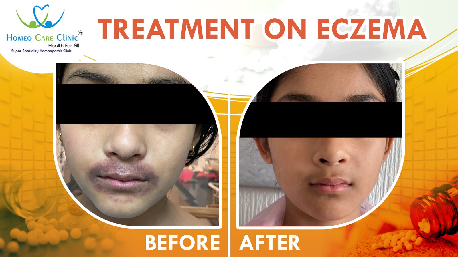 Case Study: 8-Year-Old Child Recovers From Recurring Eczema by Homeopathy |  Dr. Vaseem Choudhary | Homeo Care Clinic, Pune