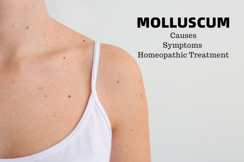 Best Homeopathic Treatment for Molluscum in Pune