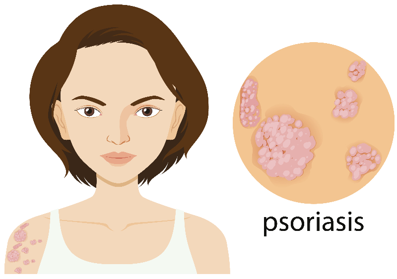 Homeopathic Treatment on Psoriatic and Guttate Arthritis