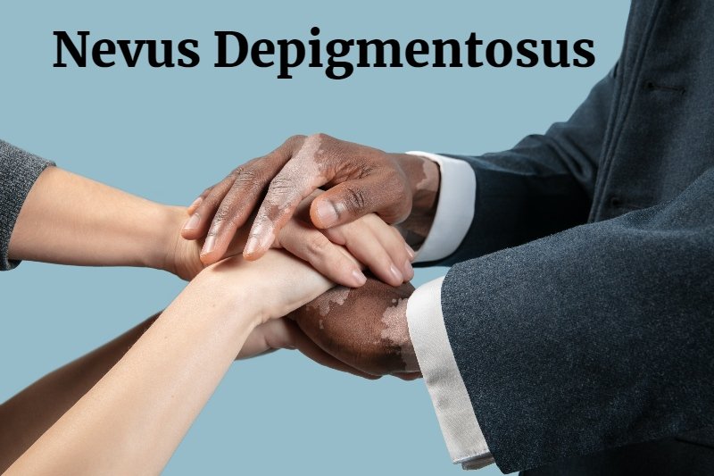 Best Treatment to cure Nevus Depigmentosus in Pune