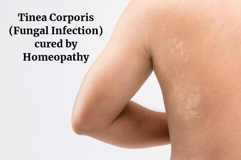 Therapeutic approach of Tinea Corporis - homeopathy360