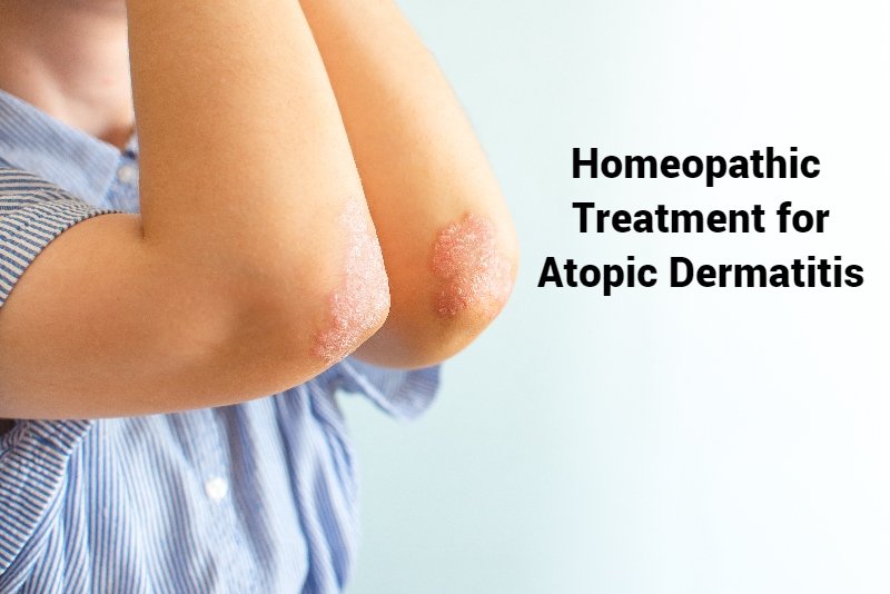 Homeopathic Treatment of Atopic Dermatitis in Pune