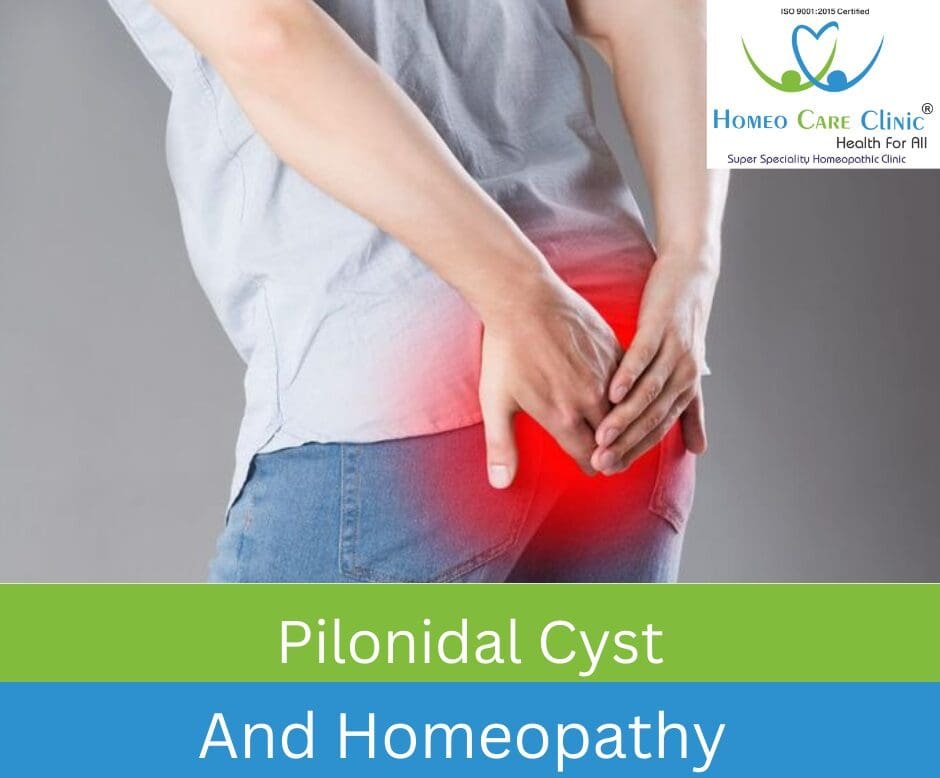 Pilonidal cyst Treatment
