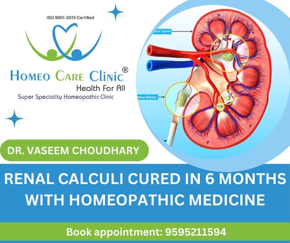 Homeopathy treatment for renal calculi cure