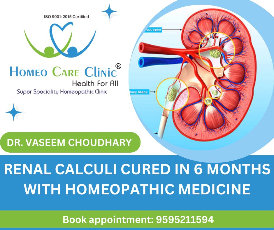 Homeopathy treatment for renal calculi cure