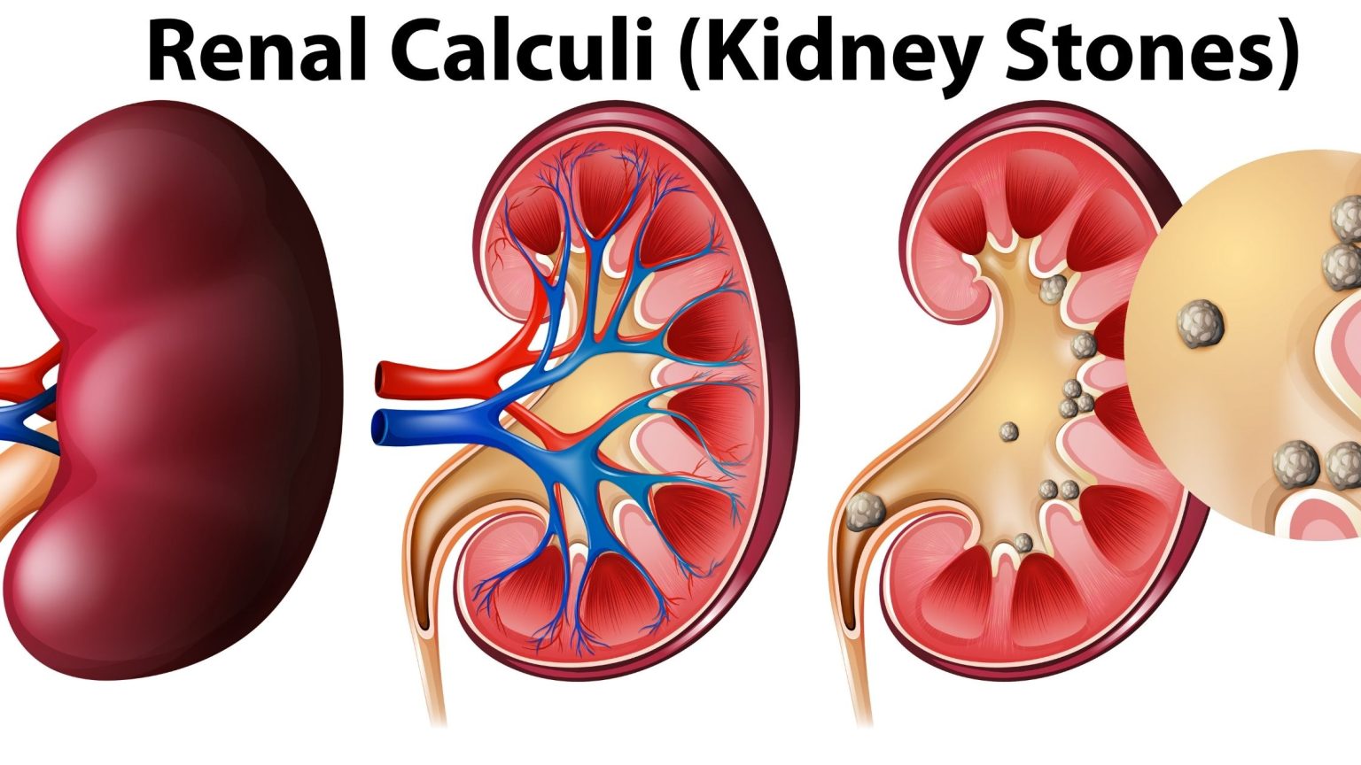Renal Calculi