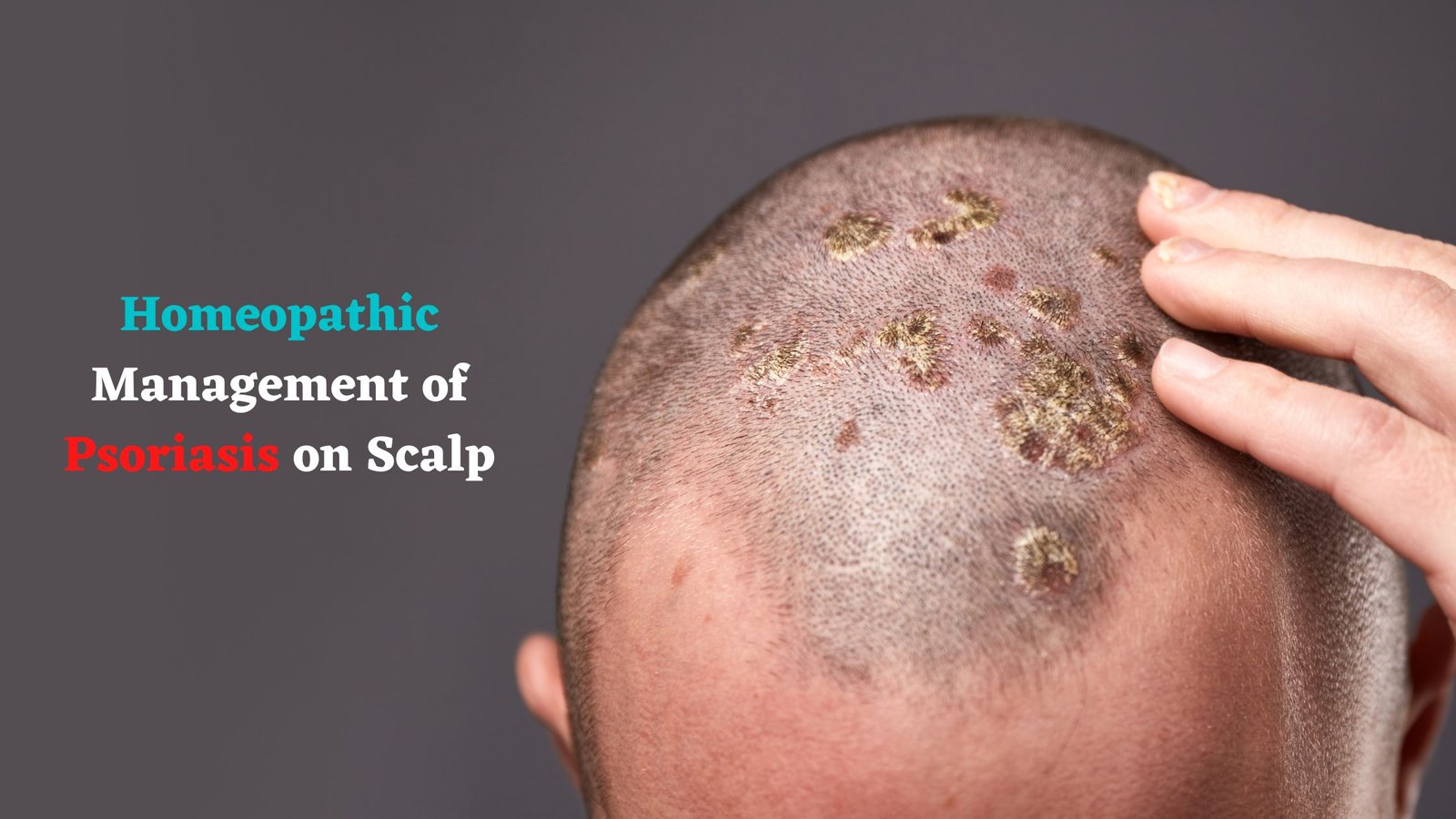 Homeopathic Management of Psoriasis on Scalp