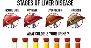 Fatty liver treatment