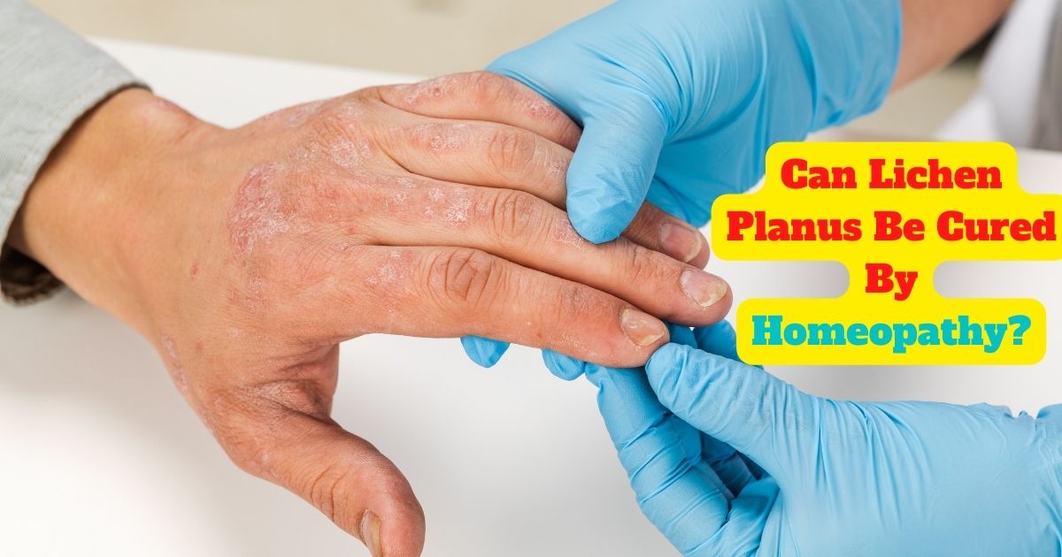 Can Lichen Planus Be Cured By Homeopathy?