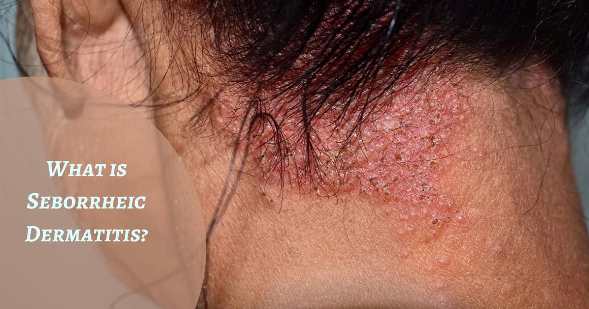 Seborrheic Dermatitis homeopathy treatment