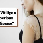 Hoemopathic treament for Vitiligo in pune