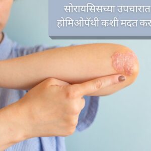 Homeopathy Helps in Treating Psoriasis