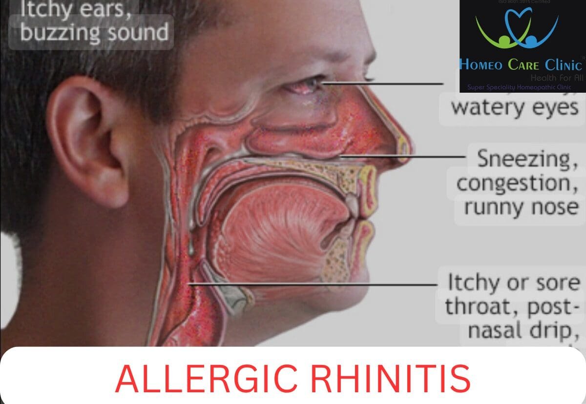 Allergic rhinitis treatment
