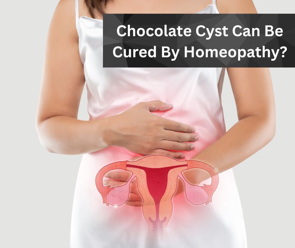 Chocolate Cyst Can Be Cured By Homeopathy