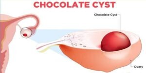 Chocolate cyst can be Cured with homeopathy