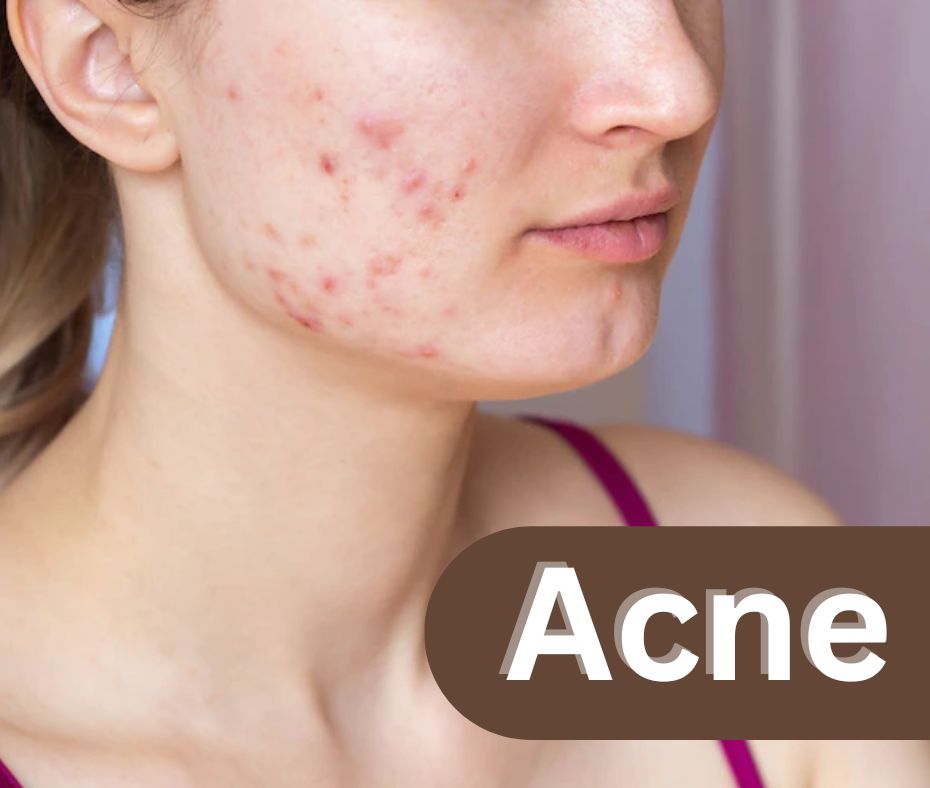 Homeopathic acne treatment