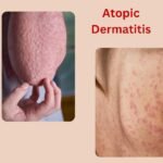 Homeopathic Treatment For Atopic Dermatitis in Pune