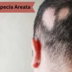 Homeopathic Treatment For Alopecia Areata