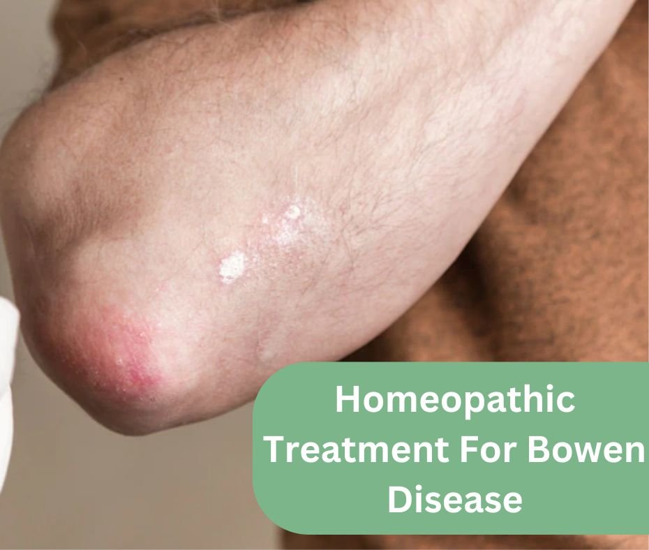 Homeopathic Treatment For Bowen Disease