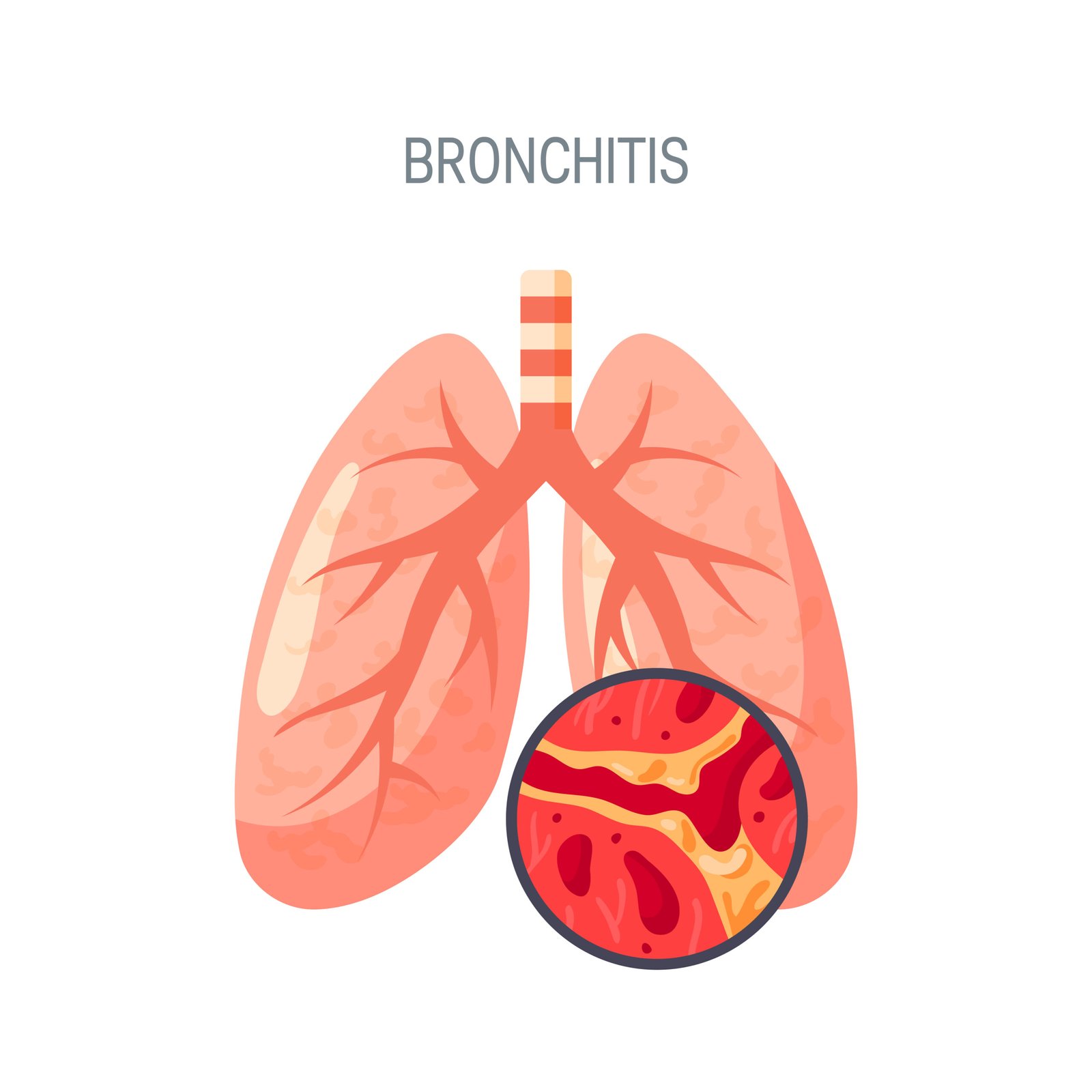 Bronchitis- symptoms and treatment | Dr. Vaseem Choudhary