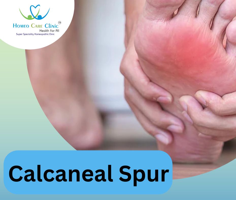 Calcaneal Spur