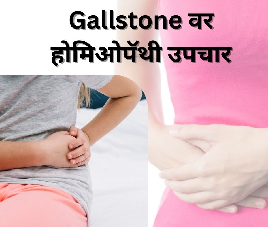 Gallstone वर होमिओपॅथी उपचार | Dr. Vaseem Choudhary, Pune