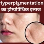 Hyperpigmentation का होम्योपैथिक इलाज | Dr. Vaseem Choudhary