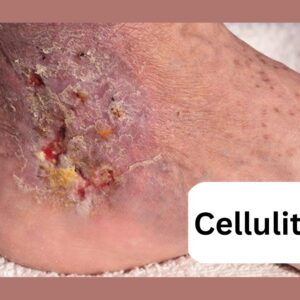 Cellulitis