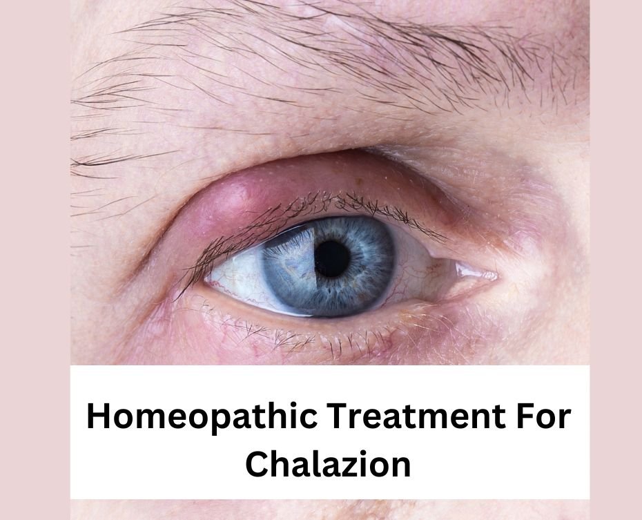 Homeopathic Treatment For Chalazion