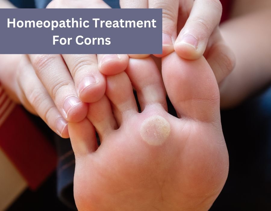 Homeopathic Treatment For Corns