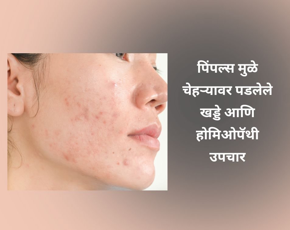पिंपल्स मुळे चेहऱ्यावर पडलेले खड्डे आणि होमिओपॅथी उपचार | Dr. Vaseem Choudhary