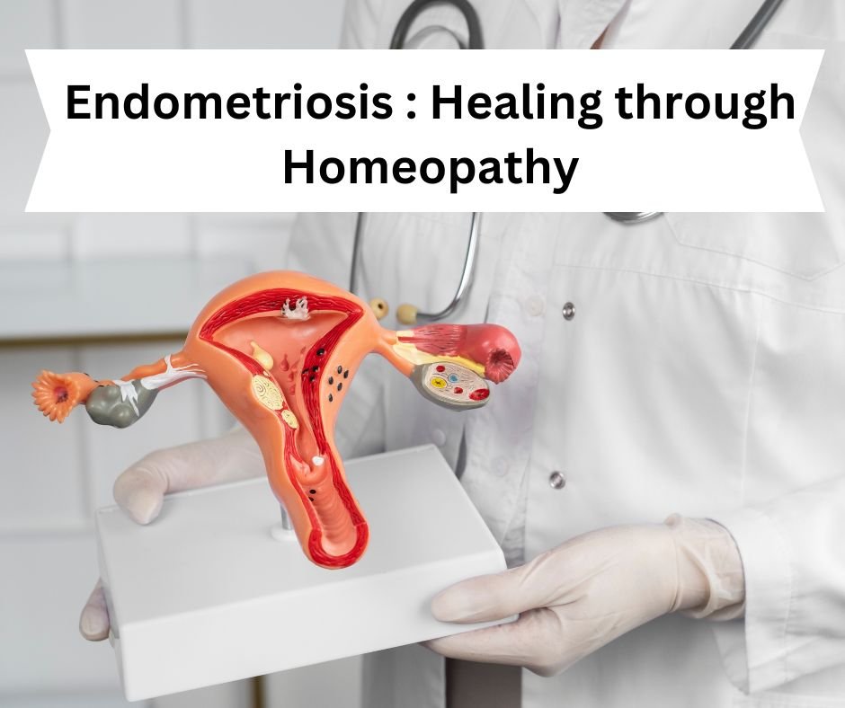 Homeopathy Treatment For Endometriosis | Dr. Vaseem Choudhary