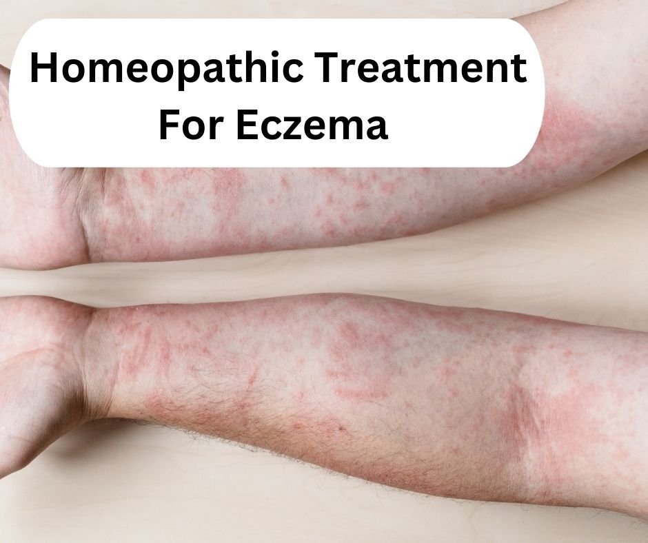 Homeopathic Treatment For Eczema