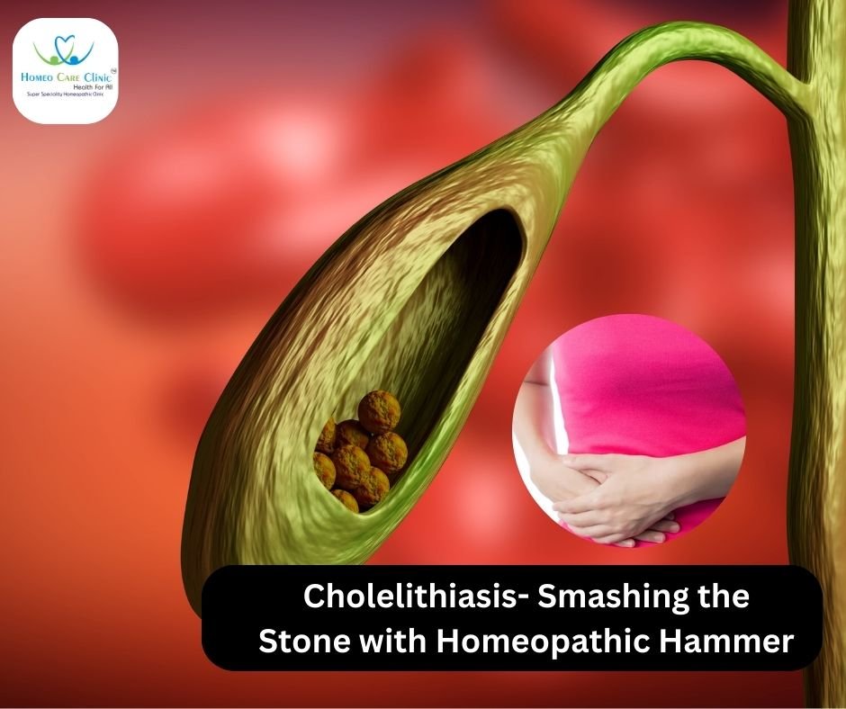 Cholelithiasis- Smashing the Stone with Homeopathic Hammer | Dr. Vaseem CHoudhary