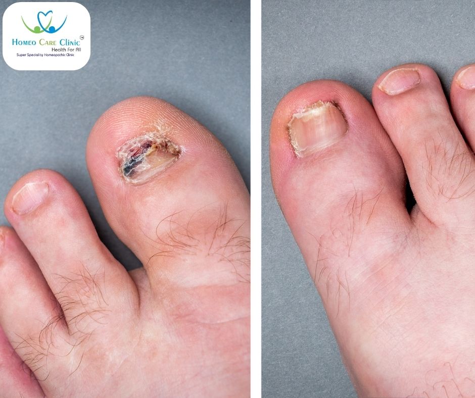 Fungal Infections