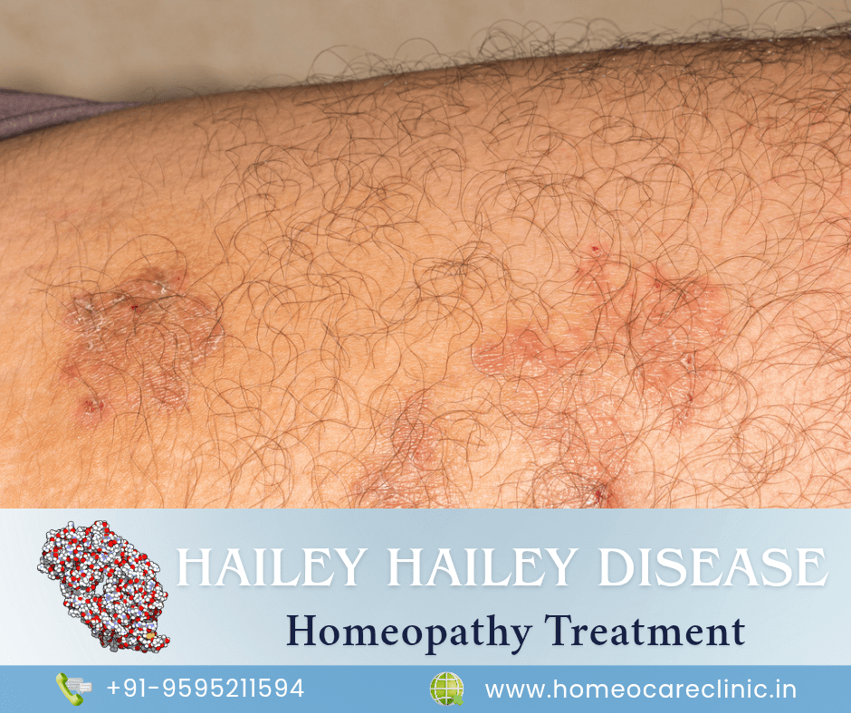 Hailey Hailey Disease